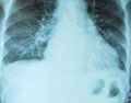 肺积水是怎么引发的?