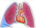 肺癌临床表现是什么？肺癌引发心包积液的症状有哪些？